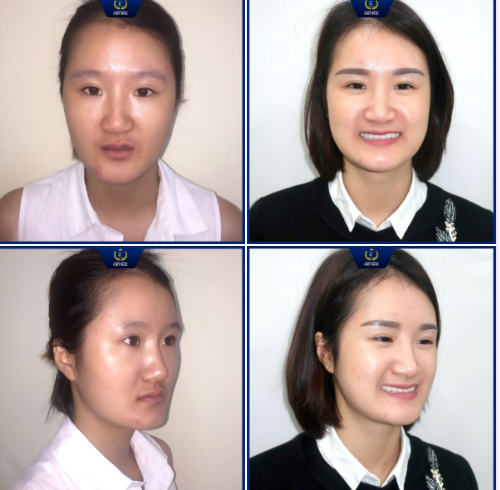 Bị chứng mất răng bẩm sinh, Nguyễn Thị Nhung (Hà Nội) dù rằng rất trẻ nhưng đã phải sống và "làm bạn" với hàm răng giả tháo lắp gần 30 năm.