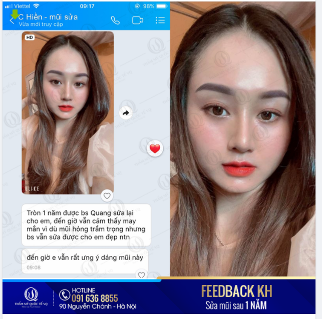 BÍ QUYẾT CHỌN ĐỊA CHỈ SỬA MŨI HỎNG UY TÍN, ĐẸP