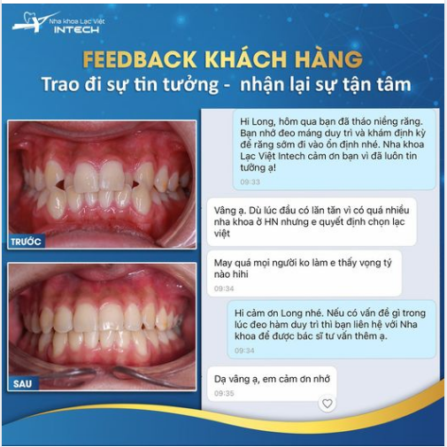 BIẾN HÌNH KHẤP KHỂNH THÀNH RĂNG ĐỀU TỰ TIN SAU 2 NĂM GẮN BÓ VỚI NIỀNG RĂNG SỨ