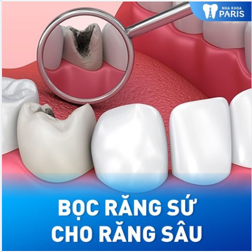 BỌC RĂNG SỨ - BIỆN PHÁP TỐI ƯU ĐIỀU TRỊ RĂNG SÂU