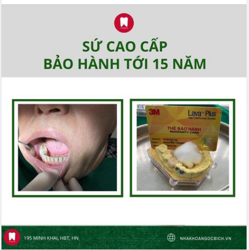BỌC SỨ CAO CẤP - BẢO HÀNH TỚI 15 NĂM