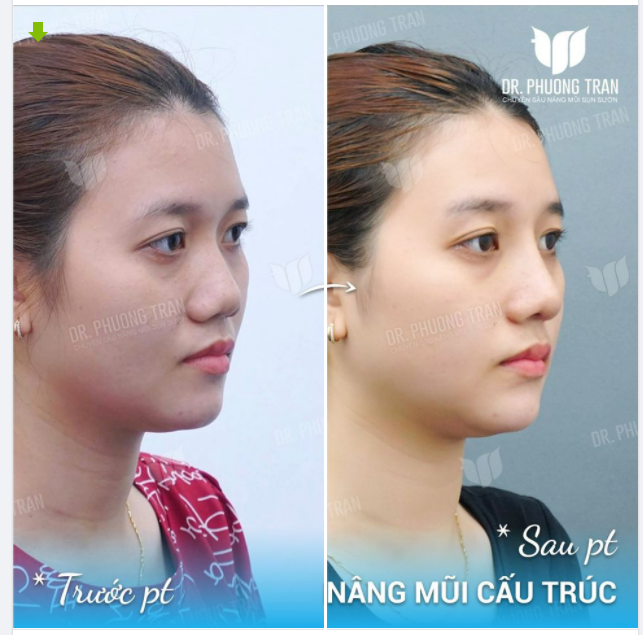 BODY SHAMING - NỖI ĐAU KÍ ỨC