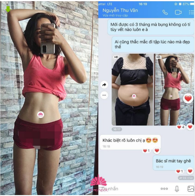 BỎNG MẮT VỚI VÒNG 2 THON GỌN SAU 3 THÁNG HÚT MỠ VASER LIPO