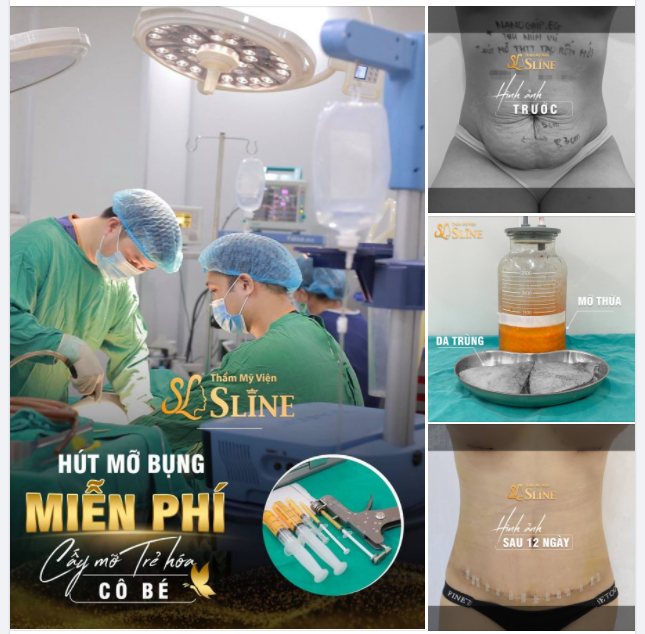 BỤNG PHẲNG EO THON - CHI PHÍ "MI NHON"