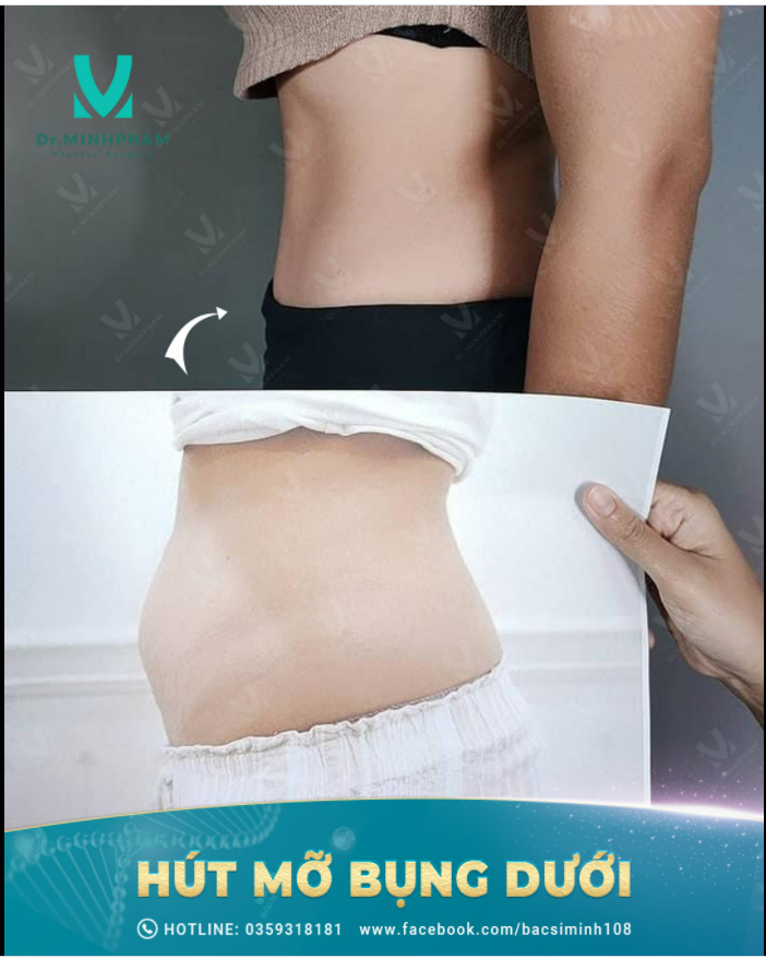 BỤNG PHẲNG – EO THON – DIỆN ĐỒ NGON HẾT MỠ BỤNG DƯỚI CHỈ VỚI 1 LẦN HÚT MỠ BIO NANO