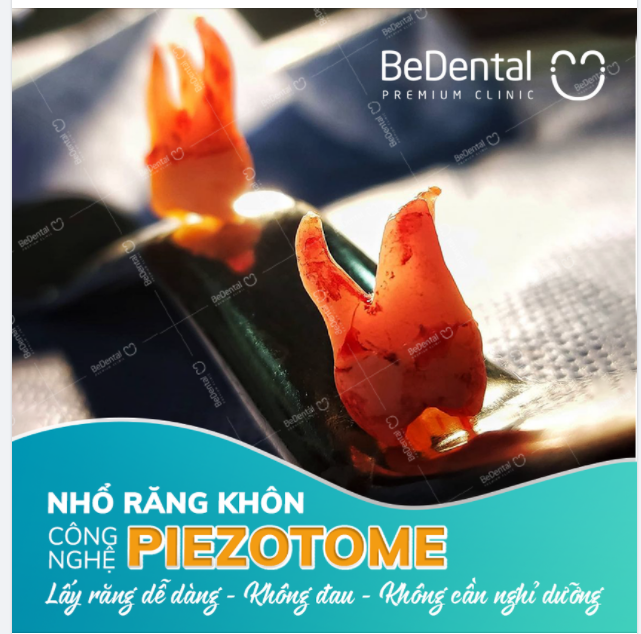 Buổi sáng chủ nhật của bác sĩ Bedental với 2 bạn răng khôn chân cong đây ạ!