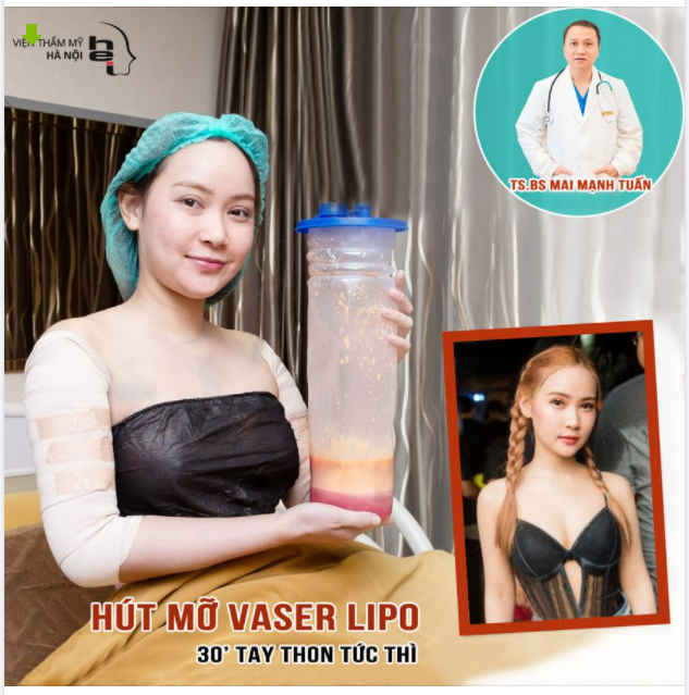 Buổi sáng đẹp trời có ngay Feedback của chị khách hàng thực hiện hút mỡ cánh tay sau 2 tháng.