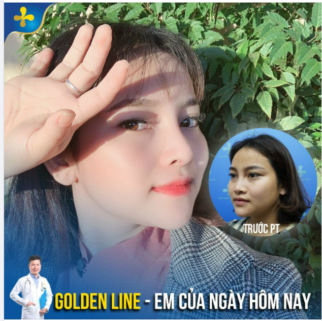 Bye bye chiếc mũi thấp, tẹt, kém xinh để chào đón dáng mũi mới SANG CHẢNH hơn!