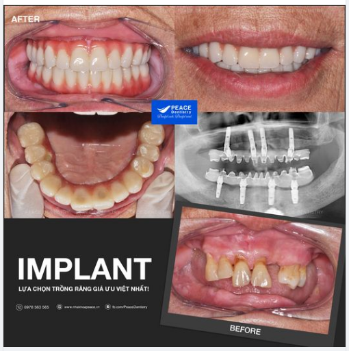 Ca lâm sàng:  ALL - ON - IMPLANT cho khách hàng lớn tuổi được hoàn thành sau 2 tuần