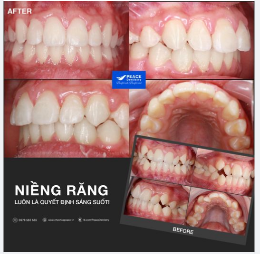 Ca lâm sàng chỉnh nha không nhổ răng, kết hợp nong 2 hàm, tháo MC sau 20 tháng