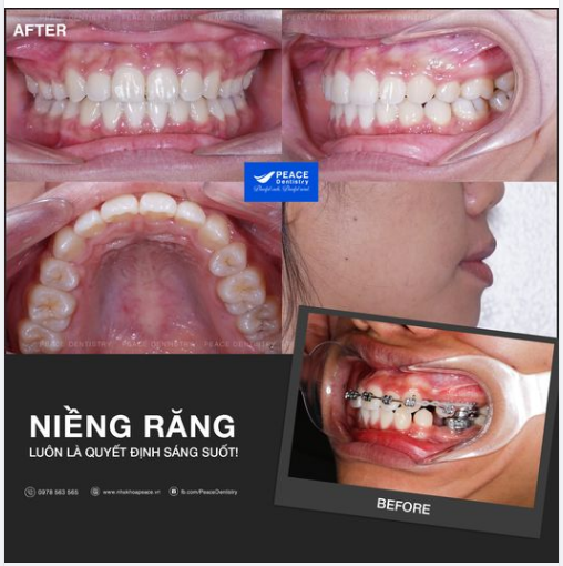 Ca lâm sàng niềng răng hô, có nhổ răng, tháo mắc cài sau 22 tháng