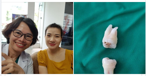 Các bạn cứ bảo nhổ răng khôn đau lắm, nhổ răng bị sưng mặt, hạn chế ăn uống rồi chẳng nói chuyện được.