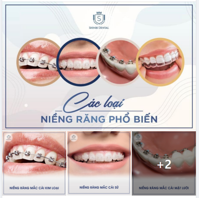 Các kiểu niềng răng phổ biến hiện nay