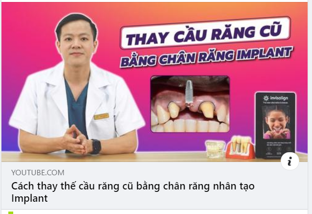 CÁCH THAY THẾ CẦU RĂNG BẰNG CHÂN RĂNG NHÂN TẠO IMPLANT