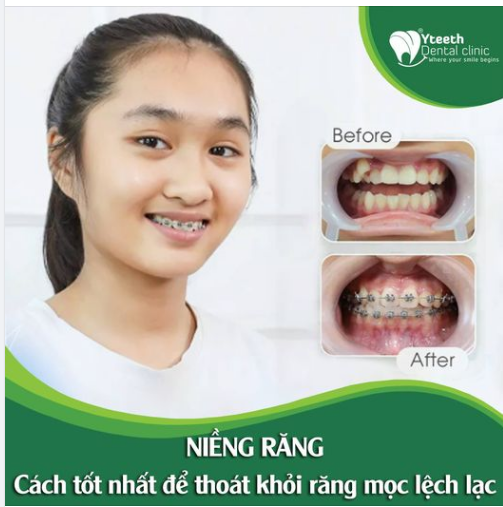 Cách tốt nhất để thoát khỏi răng mọc lệch lạc là đi niềng lại nó!