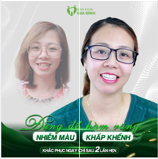 “CẢI TỔ” HÀM RĂNG – CƯỜI XINH TỎA NẮNG