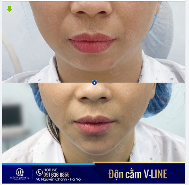 CẰM LẸM - CẰM NGẮN ​​​​​​​ - HOÁ V-LINE