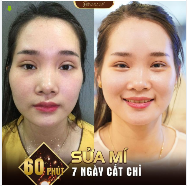 "Cảm ơn Dr.Hải Lê vì đã cho em một đôi mắt đẹp Mí sửa đều tăm tắp thế này còn đẹp hơn cả nếp mí nguyên bản. Chị em có ưng không ..."