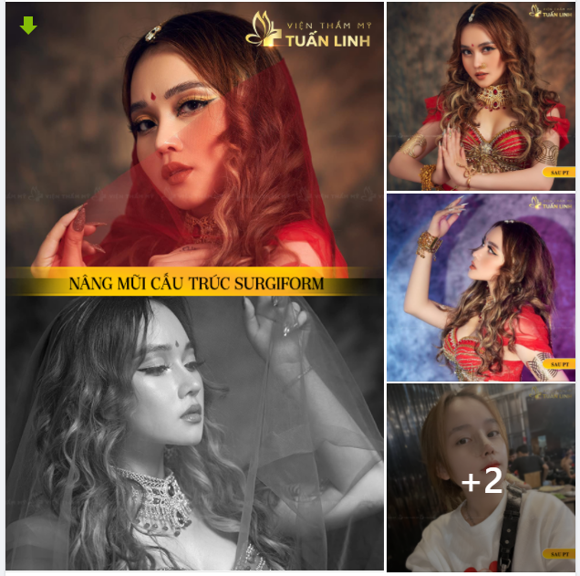 CẬN CẢNH DÁNG MŨI CẤU TRÚC SURGIFORM CỦA KHÁCH HÀNG ​​​​​​​ NHÀ TUẤN LINH SAU 3 THÁNG.