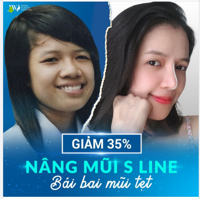 CẬN CẢNH - NÂNG MŨI S LINE - NÓI KHÔNG VỚI PHOTOSHOP