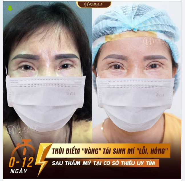 Cẩn trọng, đừng biến mình thành “Thảm họa thẩm mỹ”. Khách hàng kịp thời được "giải cứu" đúng thời điểm vàng 0-12 ngày!