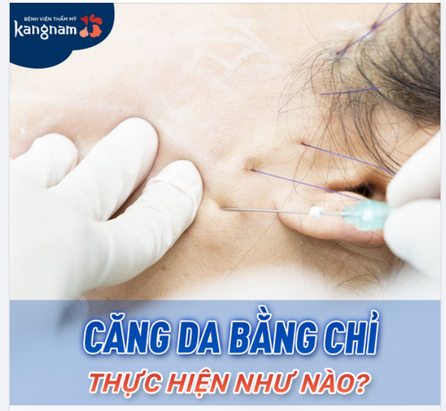 Căng da là phương pháp trẻ hóa được ưa chuộng nhất hiện nay nhờ hiệu quả tối đa và đặc biệt không xâm lấn.