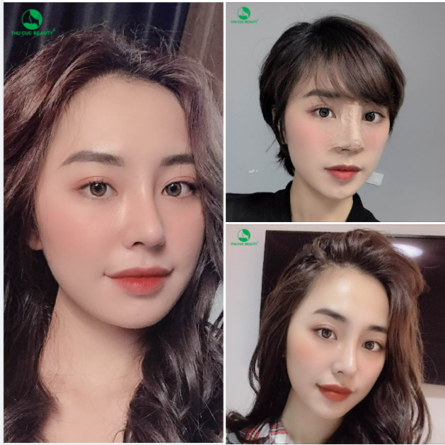 "Càng ngắm càng mê" thành quả sau khoảng 05 ngày Nâng Mũi Sạch Khuẩn tại Thu Cúc