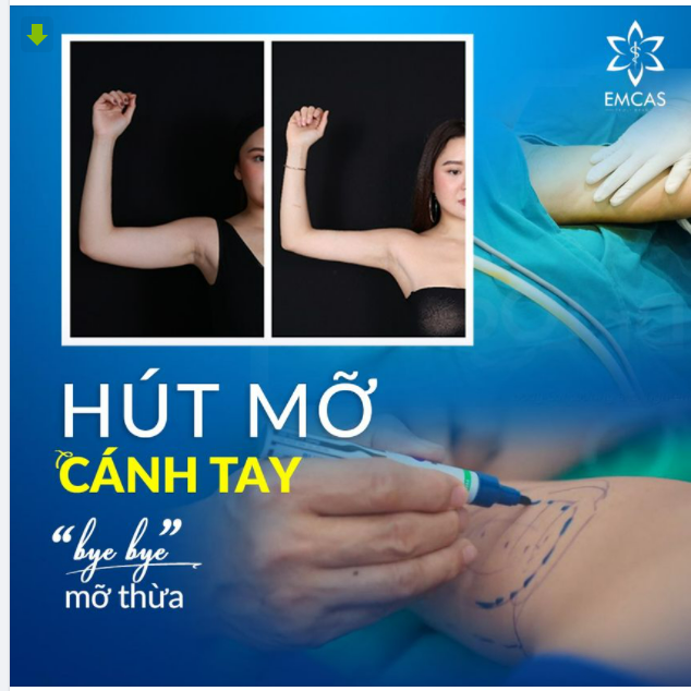 CÁNH TAY "ĐÔ" DO MỠ THỪA "NẶNG TRĨU"