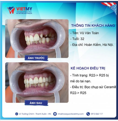 Case lắp răng thẩm mỹ cho khách hàng Văn Toàn bị mẻ vỡ nhiều răng