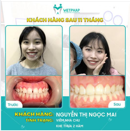Case niềng răng số 1042: Khắc phục tình trạng răng thưa chỉ sau 11 tháng