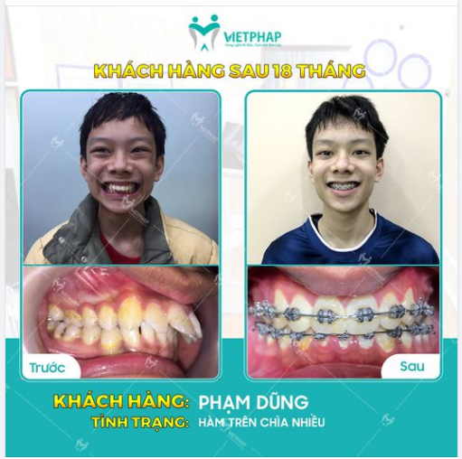 Case niềng răng số 1044: Xử lý tình trạng răng chìa với niềng răng mắc cài kim loại
