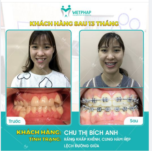 Case niềng răng số 1045: Hết khấp khểnh - Răng đều đẹp chỉ sau 13 tháng