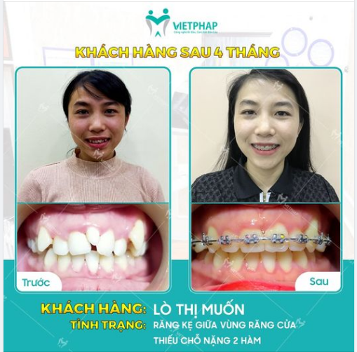 Case niềng răng số 1046: Tạm biệt răng khấp khểnh, sai khớp cắn chỉ sau 4 tháng
