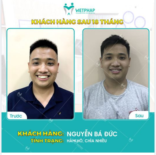 Case niềng răng số 1047: Tạm biệt răng hô chìa chỉ sau 18 tháng