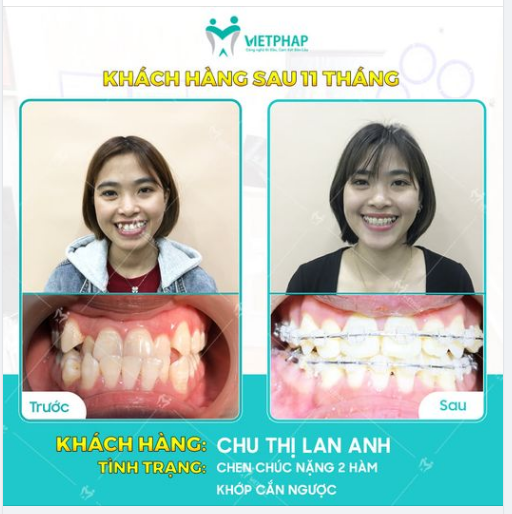 Case niềng răng số 1048: Giải cứu răng mọc chen chúc, hàm móm với niềng răng mắc cài kim loại