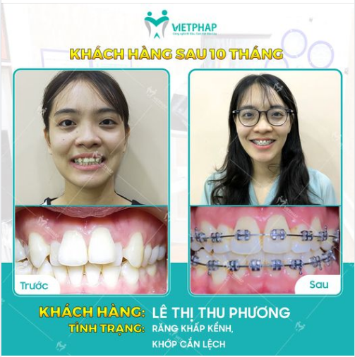 Case niềng răng số 1048: Răng khấp khểnh/ 9630 - Làm thế nào để khắc phục?