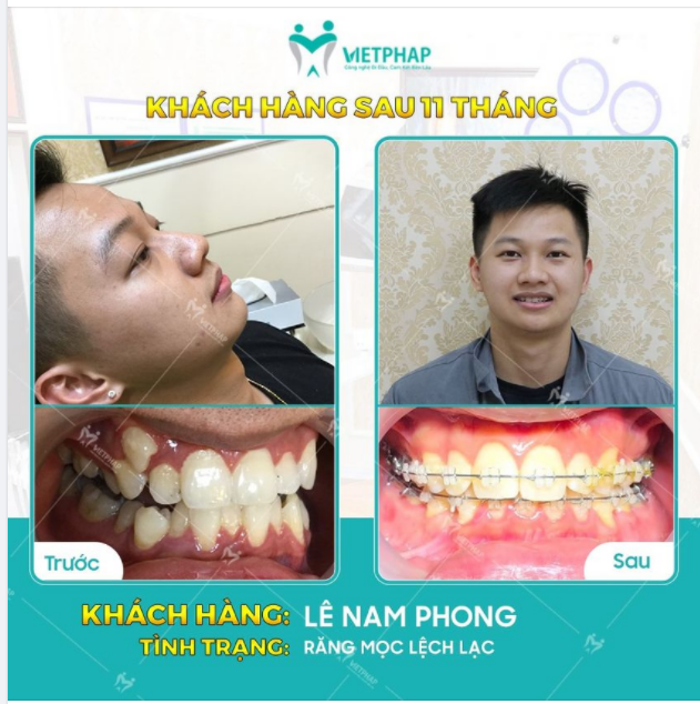 Case niềng răng số 1049: Tự tin nở nụ cười với niềng răng mắc cài sứ
