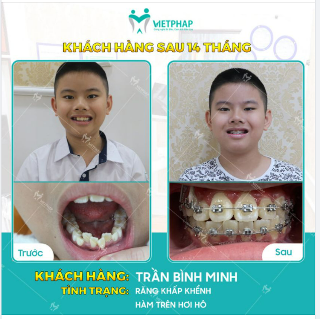 Case niềng răng số 1050: Niềng răng mắc cài kim loại