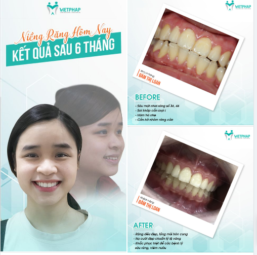 Case niềng răng số 1051: Khắc phục tình trạng sai khớp cắn với niềng răng mắc cài kim loại