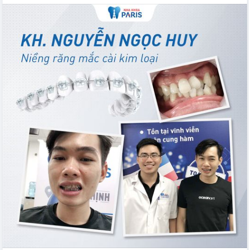 Case Niềng Răng Số 421 - Thách Thức Răng Khấp Khểnh