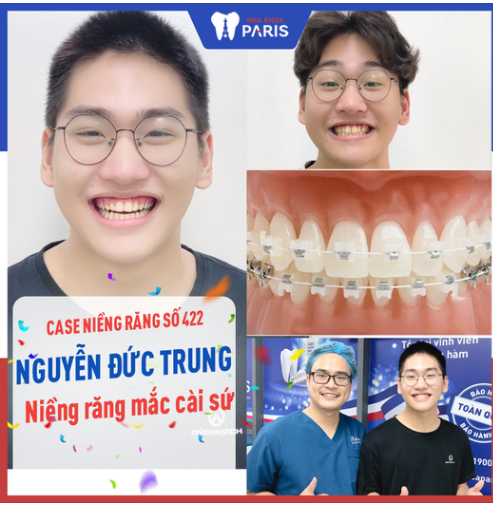 Case Niềng Răng Số 422 - Nụ Cười Tươi Rói Với Hàm Răng Đều Đẹp