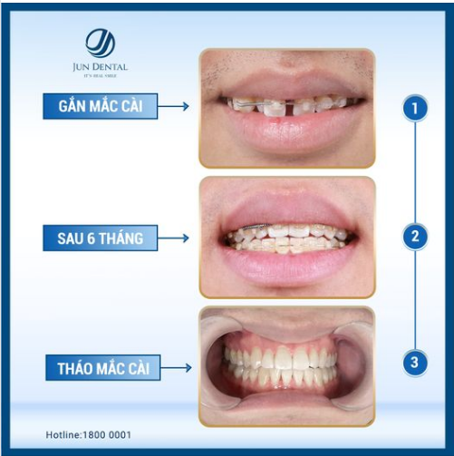 CASE NIỀNG RĂNG THƯA TẠI JUN DENTAL - THÀNH CÔNG ĐEM LẠI NỤ CƯỜI "TÀI LỘC" CHO KHÁCH HÀNG TRẦN VĂN THIÊN