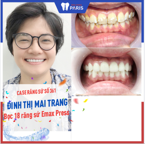 Case Răng Sứ Số 361 - Xóa Bỏ Ố Vàng, Thay Màu Trắng Sáng