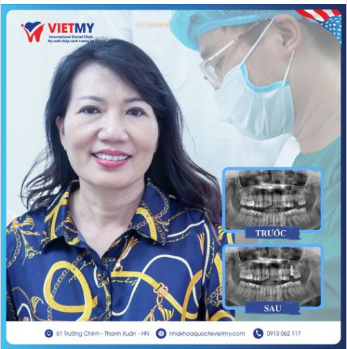 Case trồng răng Implant cho cô Hoa đến từ Đống Đa - Hà Nội