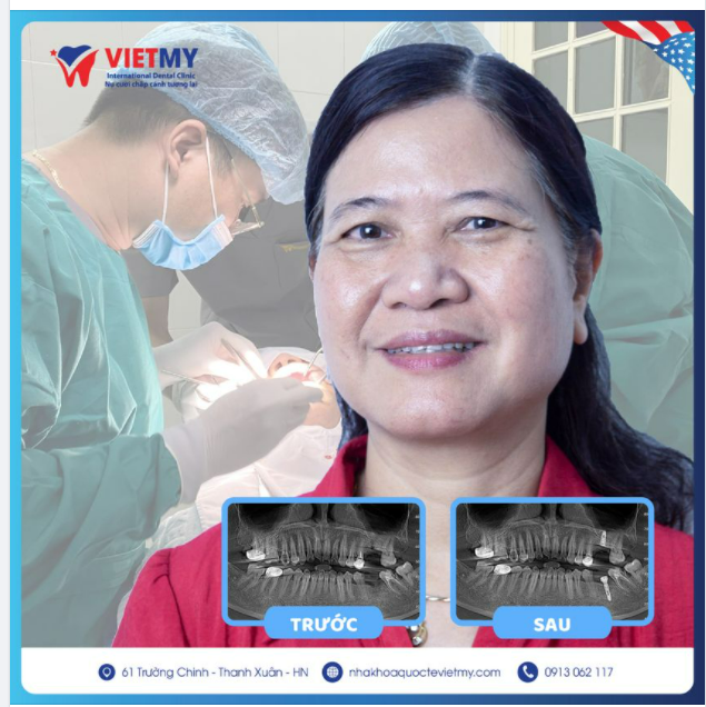 Case trồng răng Implant cho cô Hương đến từ Hòa Bình