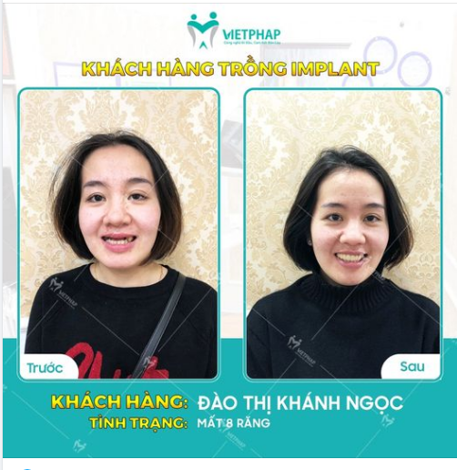 Case trồng răng Implant số 732: Phục hình 8 răng hàm trên