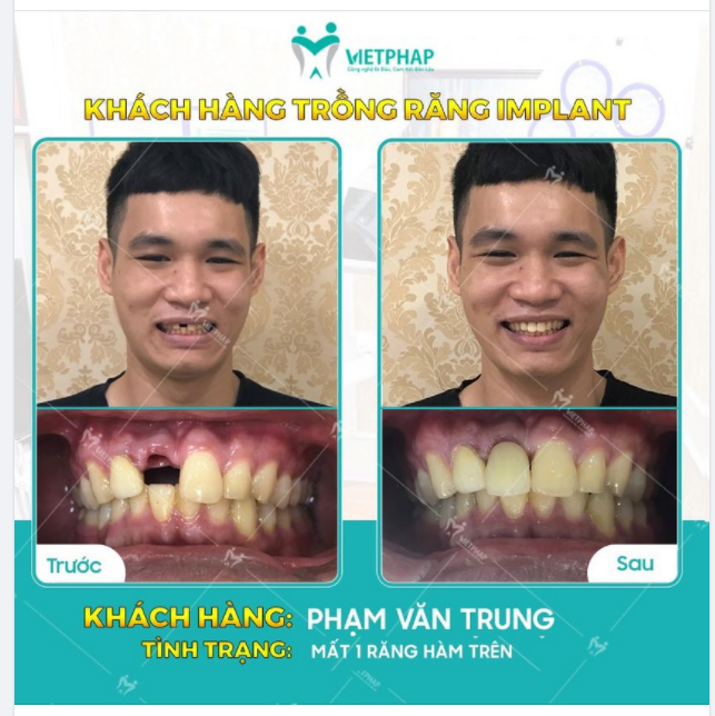 Case trồng răng Implant số 733: Phục hình răng cửa cho KH Phạm Văn Trung