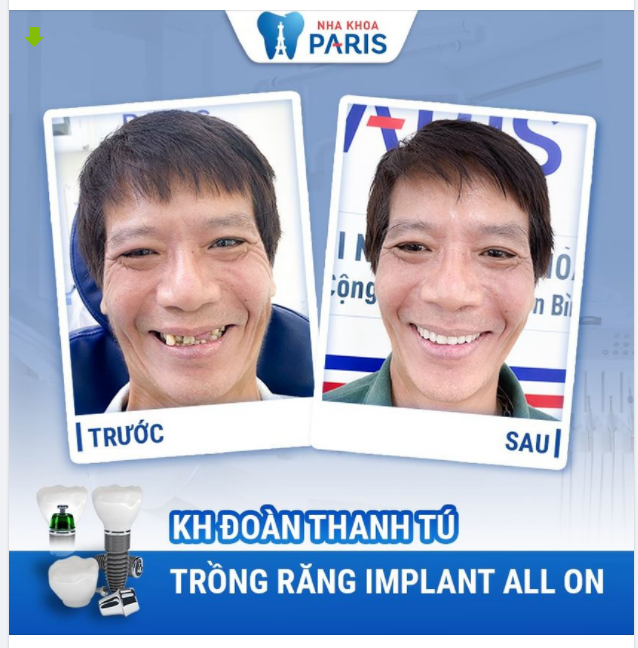 Case Trồng răng số 353 - Thay đổi nhỏ, lợi ích lớn