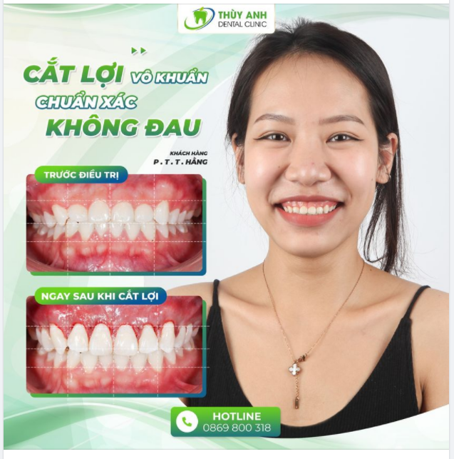CẮT LỢI VÔ KHUẨN CHUẨN XÁC - KHÔNG ĐAU