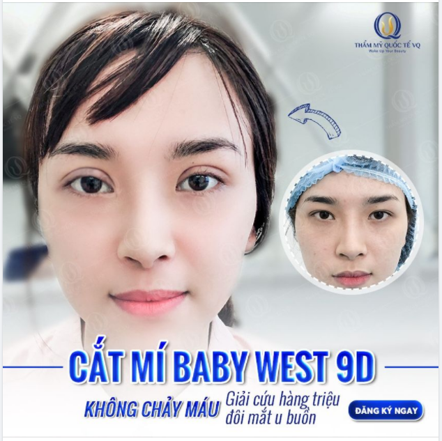CẮT MÍ BABY WEST 9D KHÔNG CHẢY MÁU - GIẢI CỨU ĐÔI MẮT U BUỒN